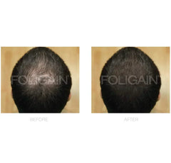 FOLIGAIN Minoxidil 5% Hair Regrowth Treatment For Men.